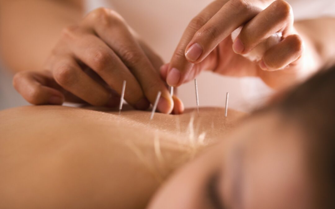 Akupunktur (TCM)